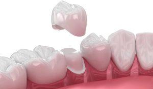 Dental Crowns
