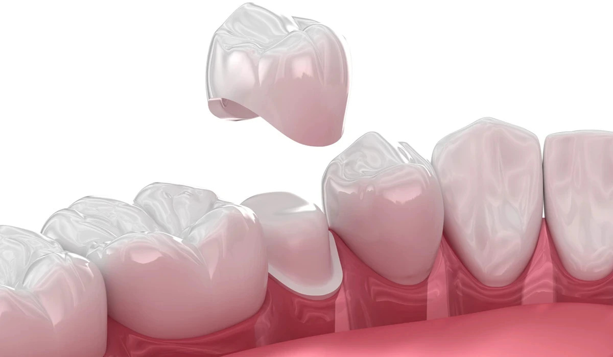 Dental Crowns