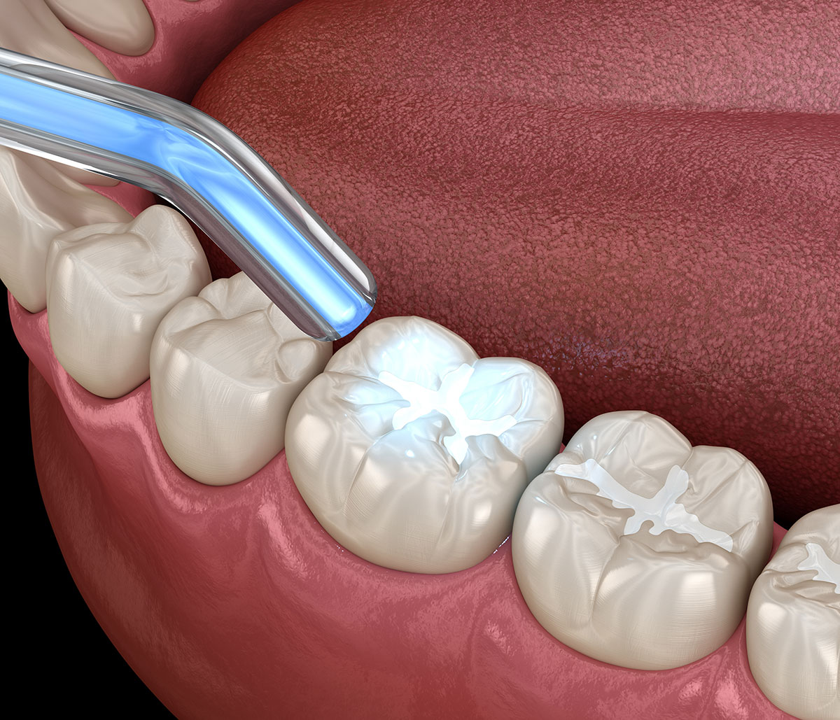 Dental Fillings
