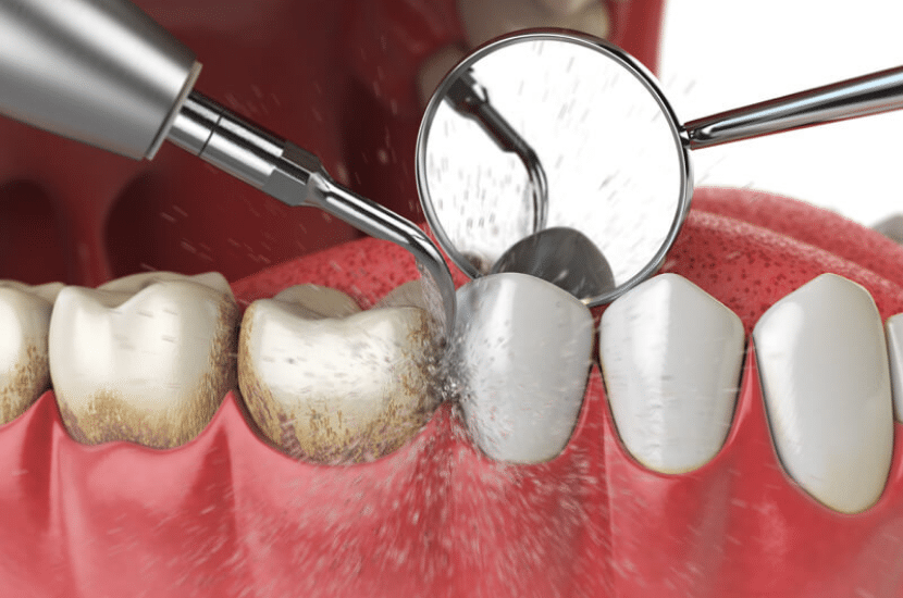 Periodontal Treatments