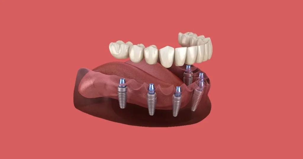 dental implants
