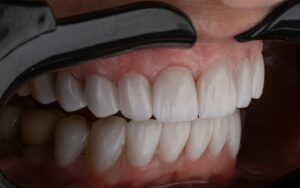 Close-up of a smile showing natural-looking front teeth